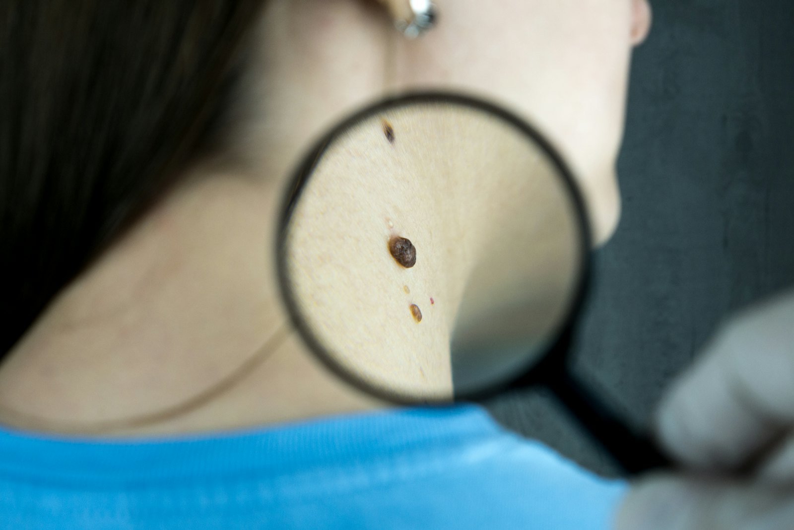 A provider checking a mole on a patient's neck with a magnifying glass